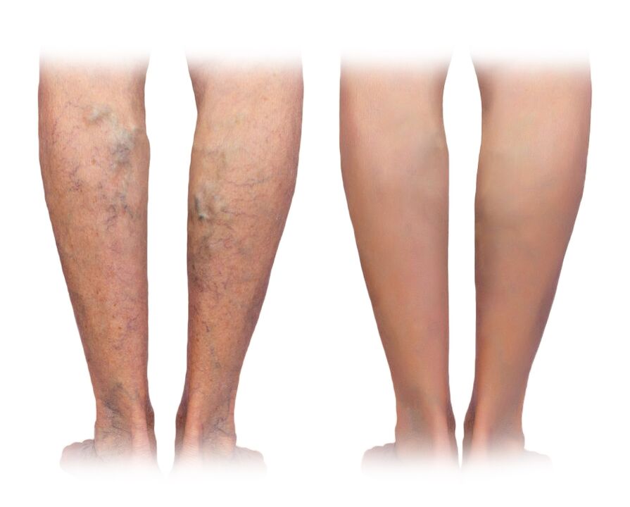 Varices piernas antes y después de usar Veniselle Crema
